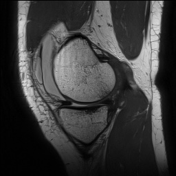 Anterior cruciate ligament rupture with Segond fracture (Radiopaedia 69043-78806 Sagittal PD 57).jpg