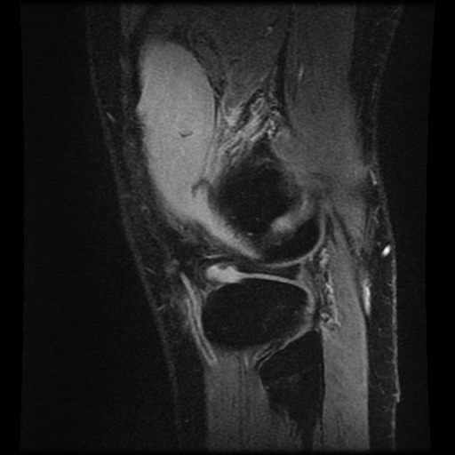 File:Anterior cruciate ligament tear (Radiopaedia 61500-69462 F 79).jpg