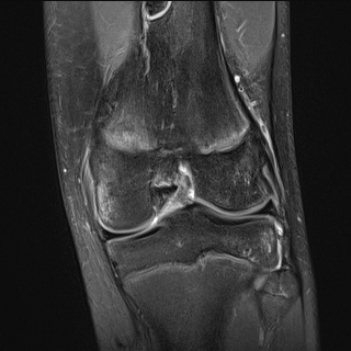 File:Anterior cruciate ligament tear - pediatric (Radiopaedia 62152-70260 Coronal PD fat sat 10).jpg
