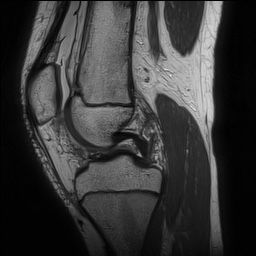 Anterior cruciate ligament tear - pediatric (Radiopaedia 62152-70260 Sagittal PD 79).jpg