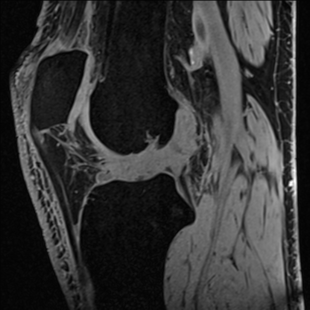 Anterior cruciate ligament tear - ramp lesion (Radiopaedia 71883-82322 Sagittal T1 vibe 69).jpg