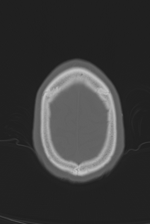 Anterior nasal spine fracture (Radiopaedia 46138-50494 Axial bone window 10).png