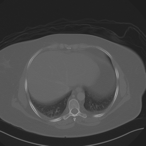 Anterior superior iliac spine avulsion fracture (Radiopaedia 44541-48244 Axial bone window 12).png