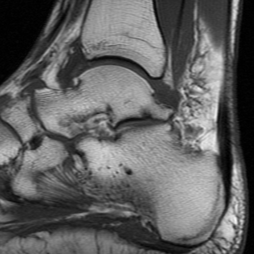 File:Anterior talofibular ligament rupture (Radiopaedia 15831-15484 Sagittal T1 11).jpg