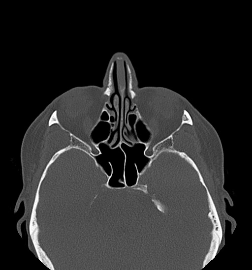 Anterior temporomandibular joint dislocation (Radiopaedia 59430-66784 Axial non-contrast 6).jpg