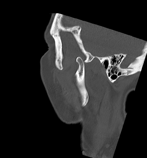 File:Anterior temporomandibular joint dislocation (Radiopaedia 59430-66784 B 7).jpg