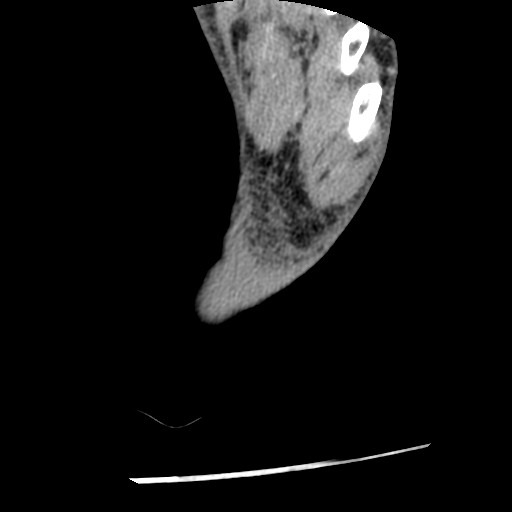 File:Anterior tibial artery false aneurysm (Radiopaedia 88984-105809 A 257).jpg