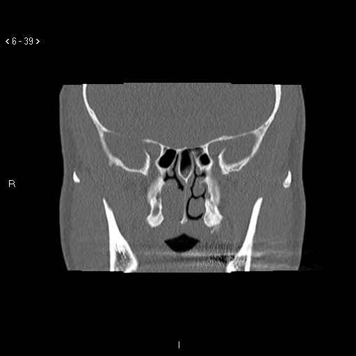 File:Antrochoanal Polyp (Radiopaedia 70510-80631 Coronal bone window 28).jpg
