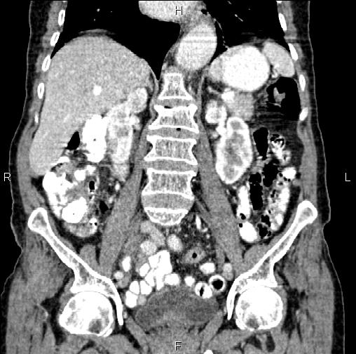 Aortic aneurysm and Lemmel syndrome (Radiopaedia 86499-102554 C 34).jpg