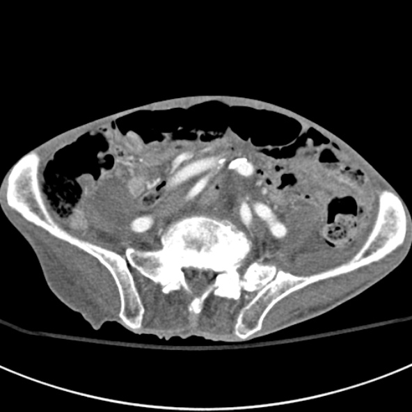 File:Aortic aneurysm with spinal destruction (Radiopaedia 42301-45410 A 75).jpg
