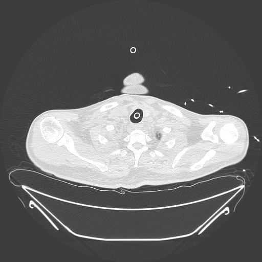 Aortic arch aneurysm (Radiopaedia 84109-99365 Axial lung window 38).jpg