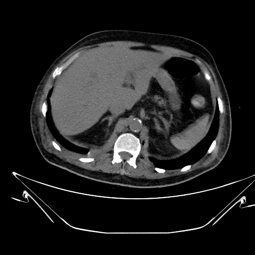 File:Aortic arch aneurysm (Radiopaedia 84109-99365 Axial non-contrast 275).jpg