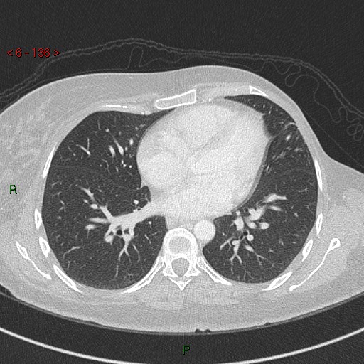 Aortic arch origin of left vertebral artery (Radiopaedia 51520-57286 Axial lung window 136).jpg