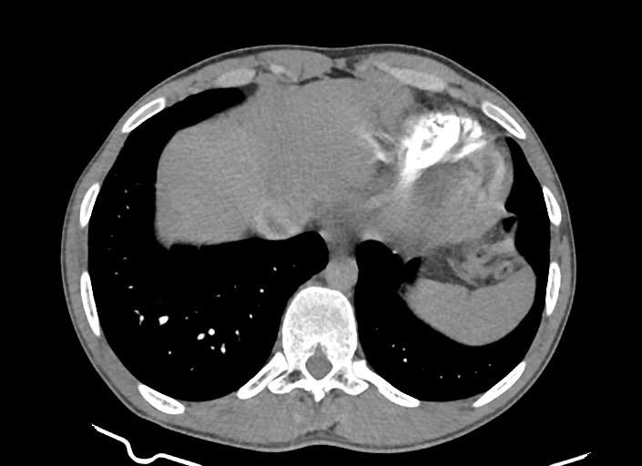 File:Aortic coarctation with aneurysm (Radiopaedia 74818-85828 A 54).jpg