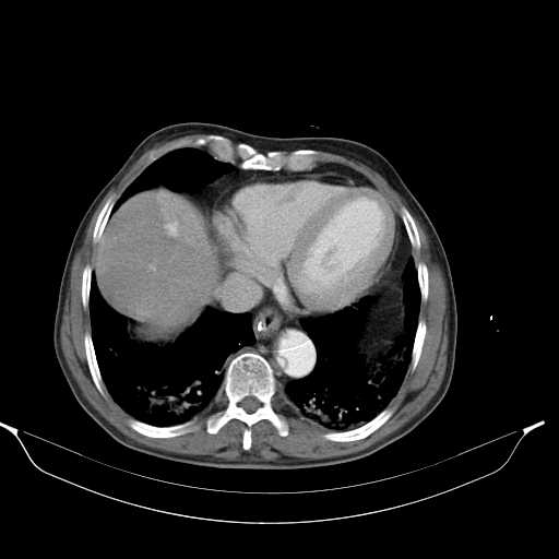 Aortic dissection- Stanford type A (Radiopaedia 22085-22085 A 31).jpg