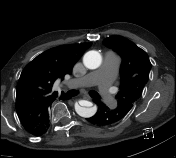 File:Aortic dissection (CTPA) (Radiopaedia 75506-86750 A 43).jpg