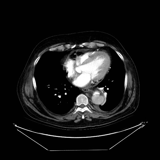 Aortic dissection (Radiopaedia 62562-71000 A 28).jpg