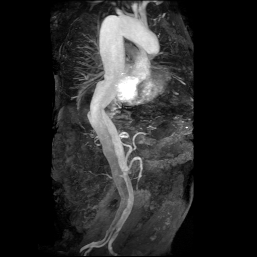 File:Aortic dissection - Stanford A - DeBakey I (Radiopaedia 23469-23551 MRA 10).jpg
