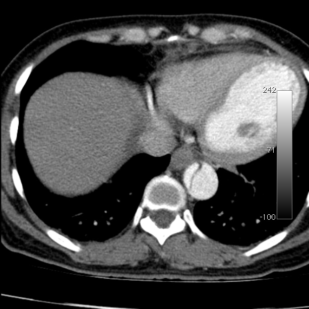 Aortic dissection - Stanford type A (Radiopaedia 29247-29659 A 59).jpg