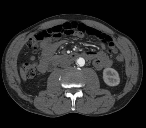 Aortic dissection - Stanford type B (Radiopaedia 73648-84437 A 163).jpg