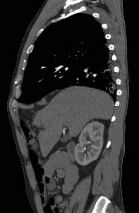 File:Aortic dissection - Stanford type B (Radiopaedia 73648-84437 C 110).jpg