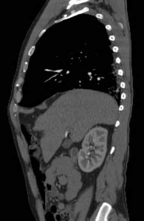 File:Aortic dissection - Stanford type B (Radiopaedia 73648-84437 C 111).jpg
