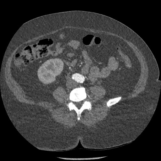 File:Aortic dissection - Stanford type B (Radiopaedia 88281-104910 A 130).jpg