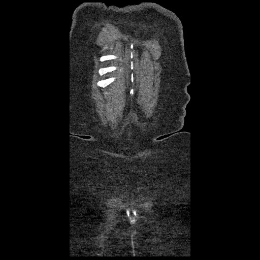 File:Aortic dissection - Stanford type B (Radiopaedia 88281-104910 B 91).jpg
