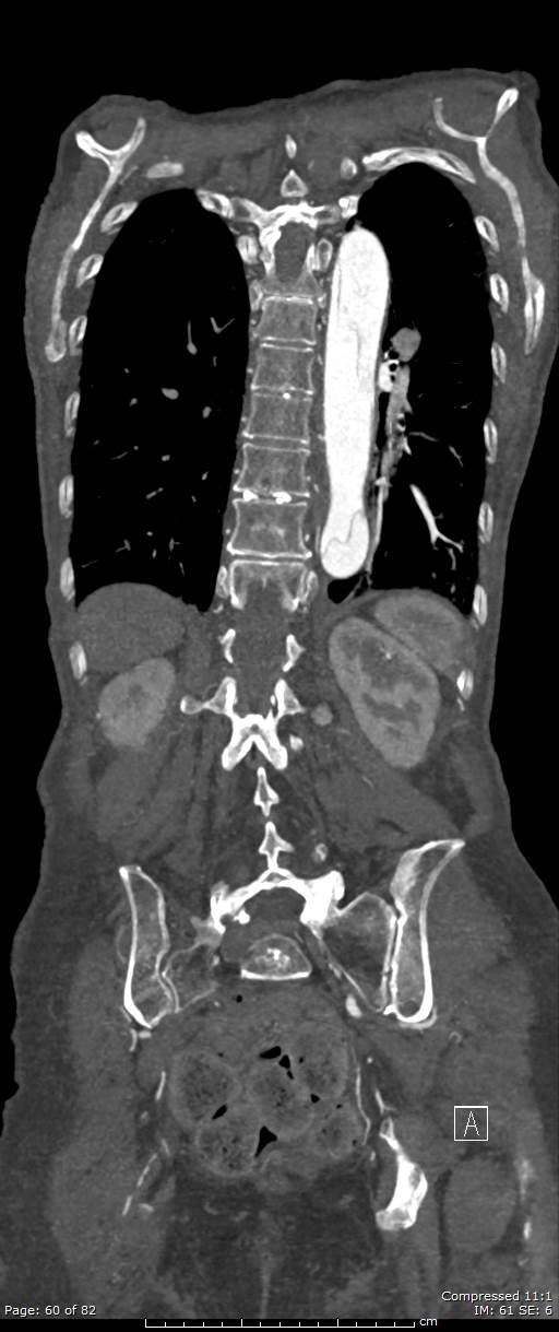 Aortic dissection with extension into aortic arch branches (Radiopaedia 64402-73204 A 60).jpg