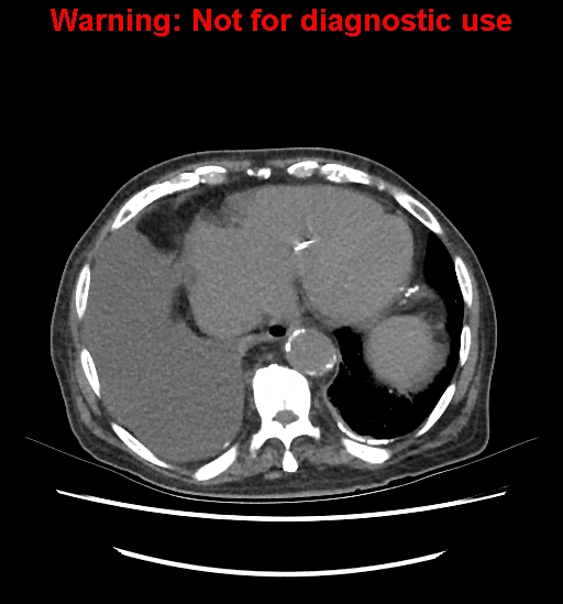 Aortic graft infection (Radiopaedia 44979-48907 Axial non-contrast 16).jpg
