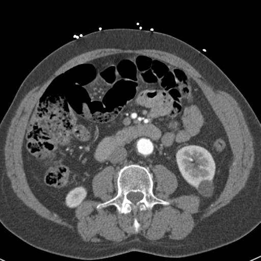 Aortic intramural hematoma (Radiopaedia 31139-31838 B 108).jpg