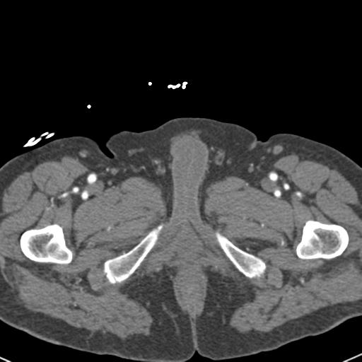 File:Aortic intramural hematoma (Radiopaedia 31139-31838 B 182).jpg