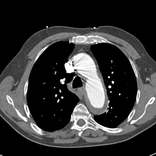 Aortic intramural hematoma (Radiopaedia 31139-31838 B 31).jpg