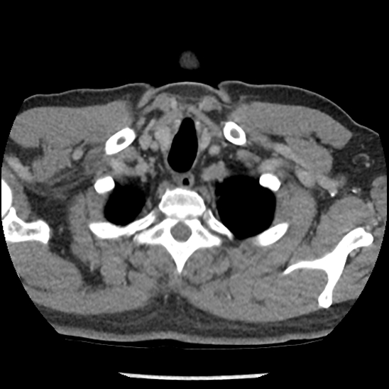 Aortic intramural hematoma (type B) (Radiopaedia 79323-92387 Axial C+ delayed 1).jpg