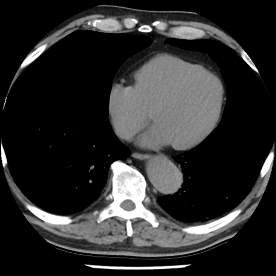 File:Aortic intramural hematoma (type B) (Radiopaedia 79323-92387 Axial non-contrast 37).jpg