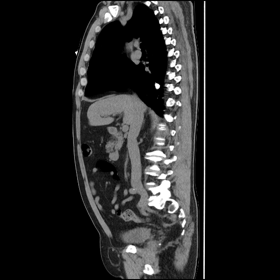 Aortic intramural hematoma (type B) (Radiopaedia 79323-92387 G 19).jpg