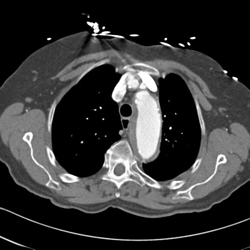 Aortic intramural hematoma from penetrating atherosclerotic ulcer (Radiopaedia 31137-31836 A 20).jpg