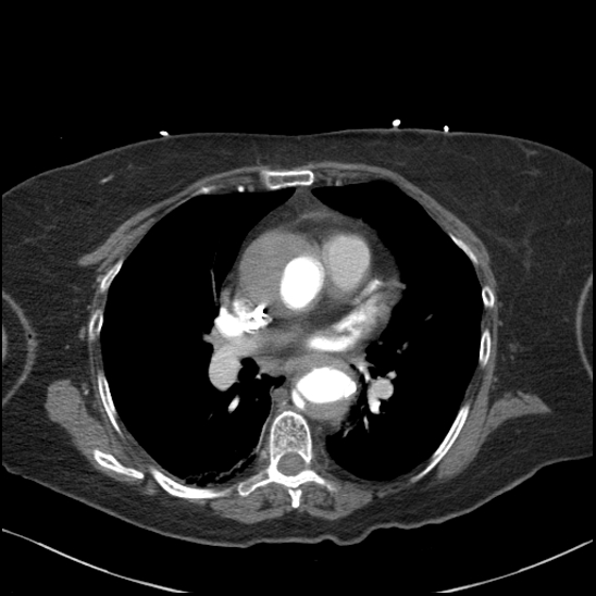 Aortic intramural hematoma with dissection and intramural blood pool (Radiopaedia 77373-89491 B 62).jpg