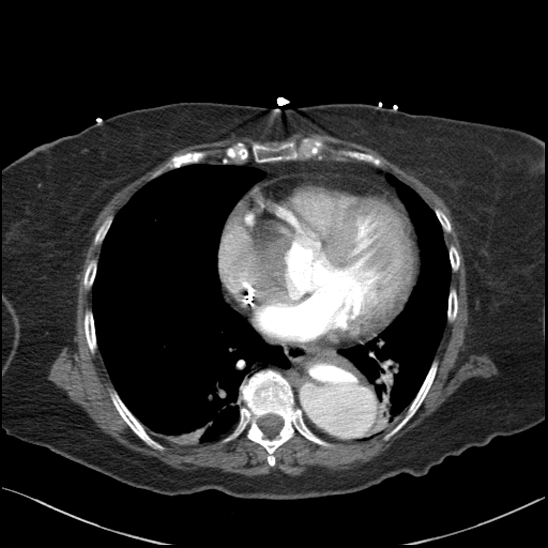 Aortic intramural hematoma with dissection and intramural blood pool (Radiopaedia 77373-89491 B 74).jpg