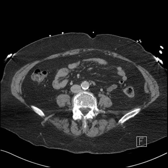 Aortic intramural hematoma with dissection and intramural blood pool (Radiopaedia 77373-89491 E 55).jpg