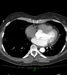 Aortic valve endocarditis (Radiopaedia 87209-103485 C 61).jpg