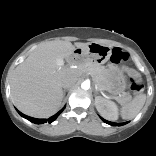 File:Aortic valve non-coronary cusp thrombus (Radiopaedia 55661-62189 B 52).png