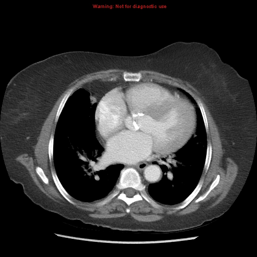 File:Aortic valve stenosis (Radiopaedia 14480-14423 C 10).jpg