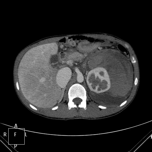 File:Aorto-left renal vein fistula (Radiopaedia 45534-49628 A 9).jpg