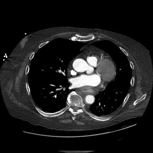 Aortoesophageal fistula with endovascular repair (Radiopaedia 73781-84592 Axial C+ CTPA 91).jpg