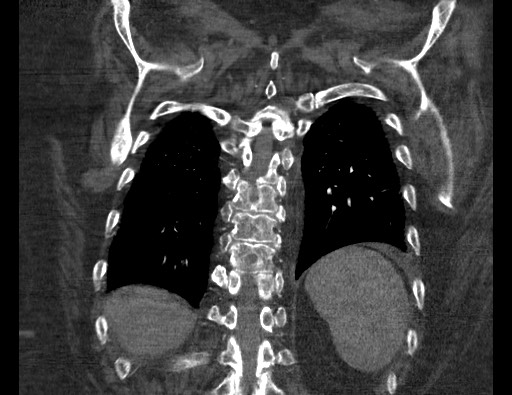 Aortoesophageal fistula with endovascular repair (Radiopaedia 73781-84592 Coronal C+ CTPA 111).jpg
