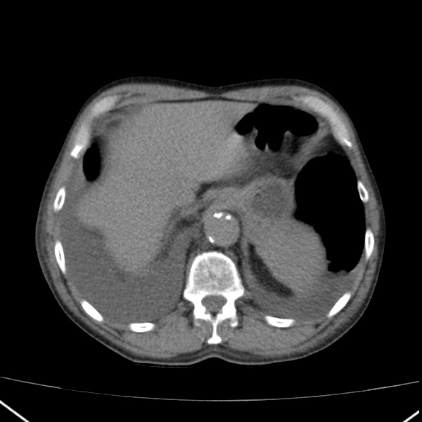 Aortoiliac occlusive disease (Radiopaedia 32134-33076 Axial non-contrast 8).jpg
