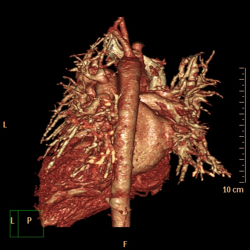 File:Aortopulmonary septal defect (Radiopaedia 41990-45013 3D reconstruction 10).jpg