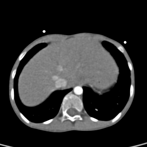 File:Aortopulmonary window, interrupted aortic arch and large PDA giving the descending aorta (Radiopaedia 35573-37074 B 82).jpg