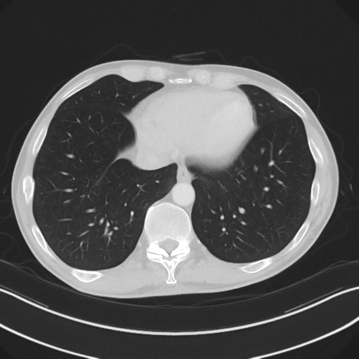 Apical pleural calcification (Radiopaedia 46141-50499 Axial lung window 54).png